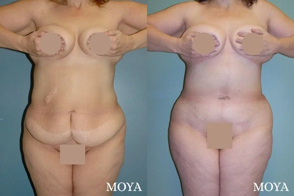 Corset Body Lift® (standard): BMI 32 - Before and After 1