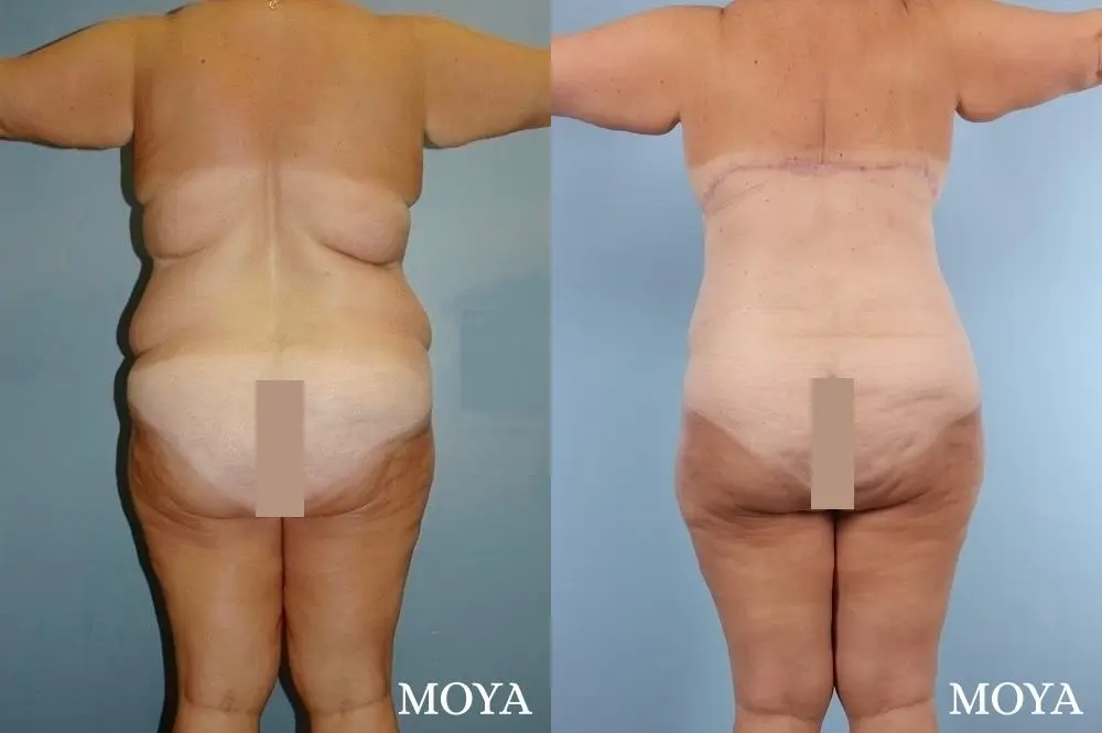 Corset Body Lift® (standard): BMI 38 - Before and After 3