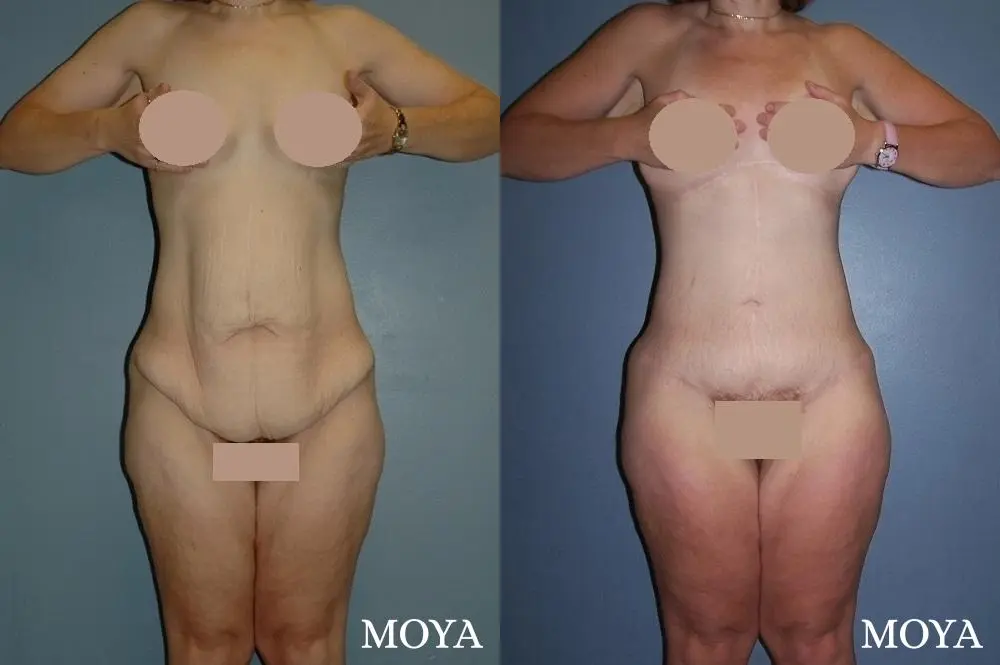 Corset Body Lift® (standard): BMI 24 - Before and After  