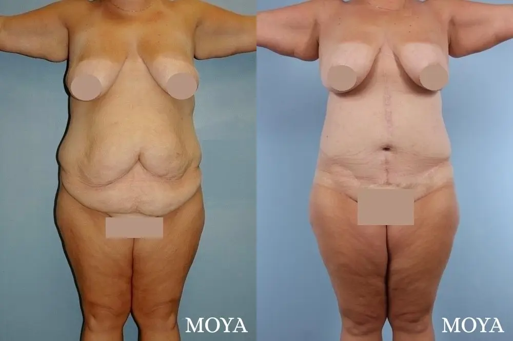 Corset Body Lift® (standard): BMI 38 - Before and After 1