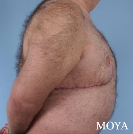 Upper Body Lift: Patient 3 - After Image 1