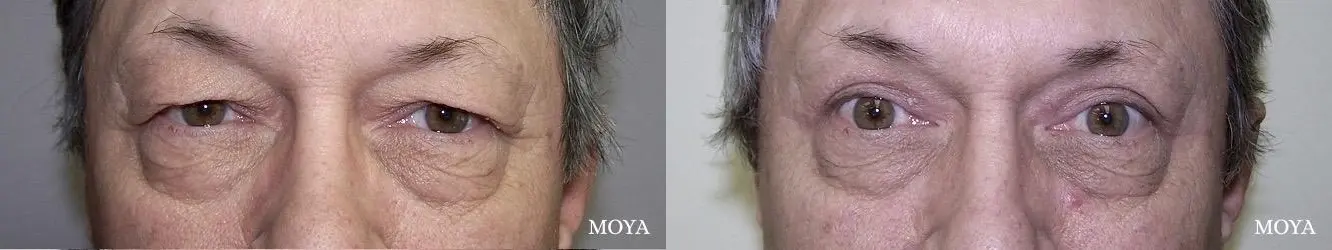 Eyelid Lift: Patient 16 - Before and After  