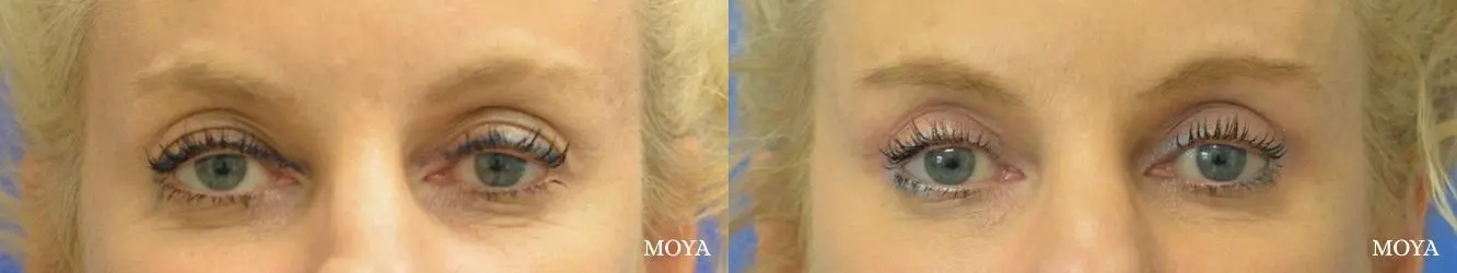 Eyelid Lift: Patient 14 - Before and After 1