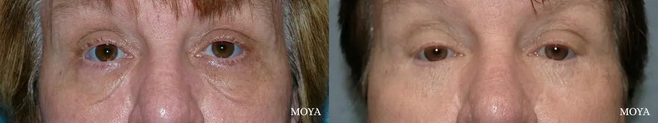 Eyelid Lift: Patient 13 - Before and After  