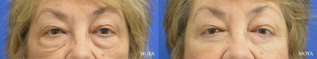 Eyelid Lift: Patient 12 - Before and After  