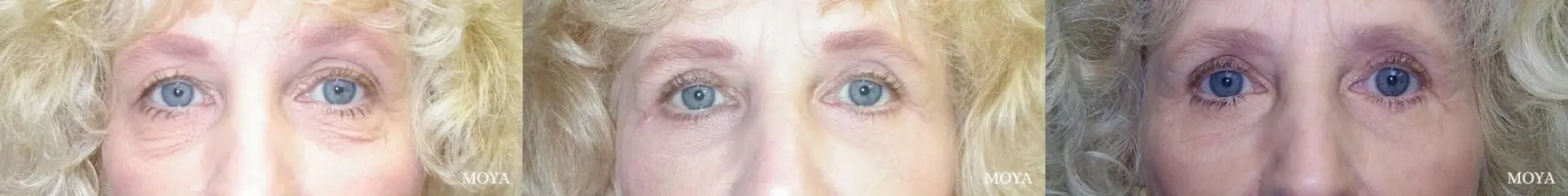 Eyelid Lift: Patient 5 - Before and After  