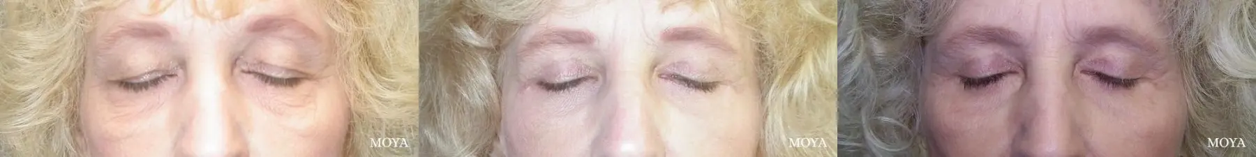 Eyelid Lift: Patient 5 - Before and After 2