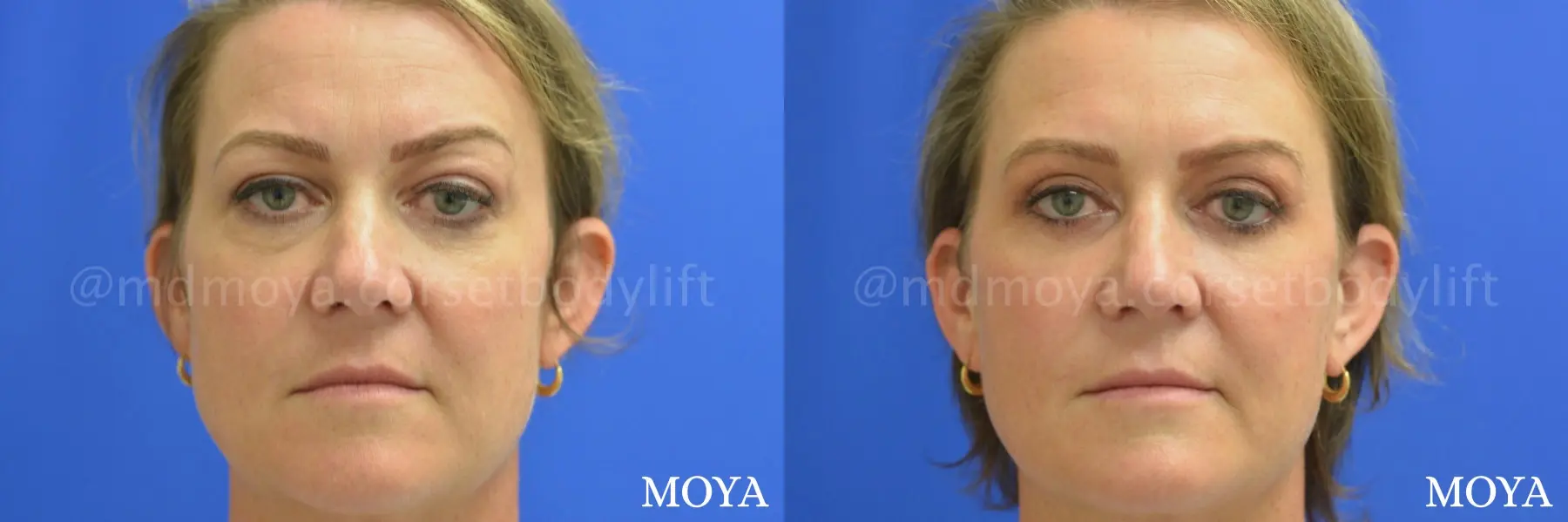 Eyelid Lift: Patient 1 - Before and After 1