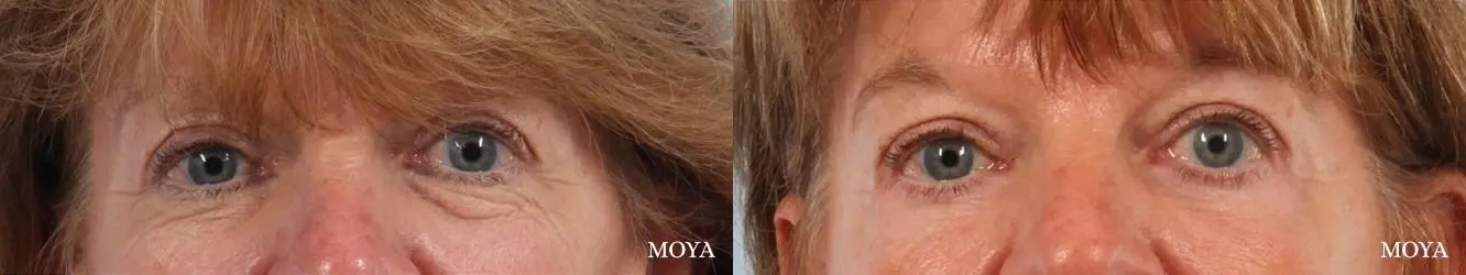 Eyelid Lift: Patient 10 - Before and After  