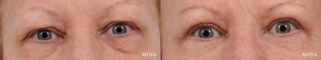 Eyelid Lift: Patient 6 - Before and After 1