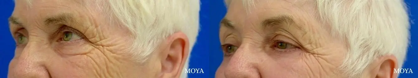 Eyelid Lift: Patient 11 - Before and After 2