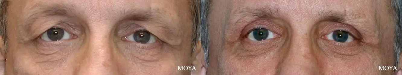 Eyelid Lift: Patient 15 - Before and After  