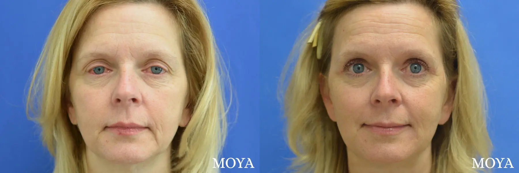 Eyelid Lift: Patient 3 - Before and After  