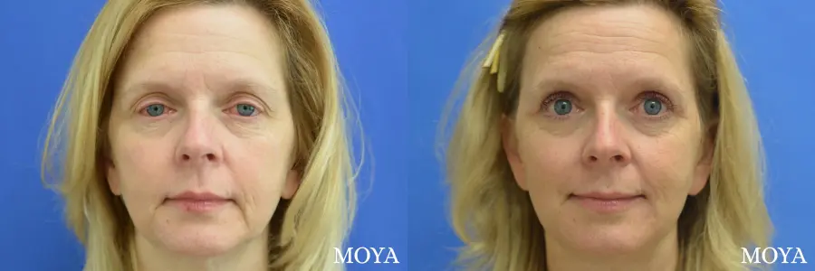 Eyelid Lift: Patient 3 - Before and After  