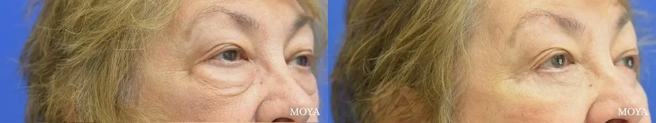Eyelid Lift: Patient 12 - Before and After 2