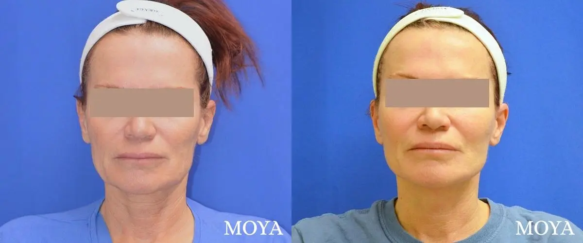 Facelift (Limited Lower) - Before and After 2