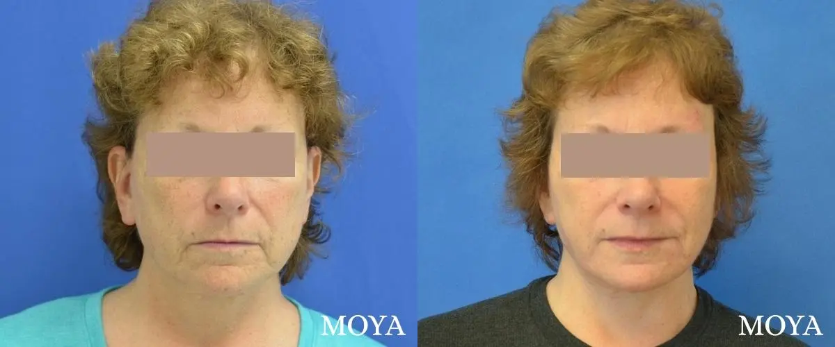 Facelift (Lower) - Before and After 2