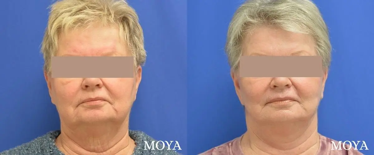 Facelift (Limited Lower) - Before and After 2