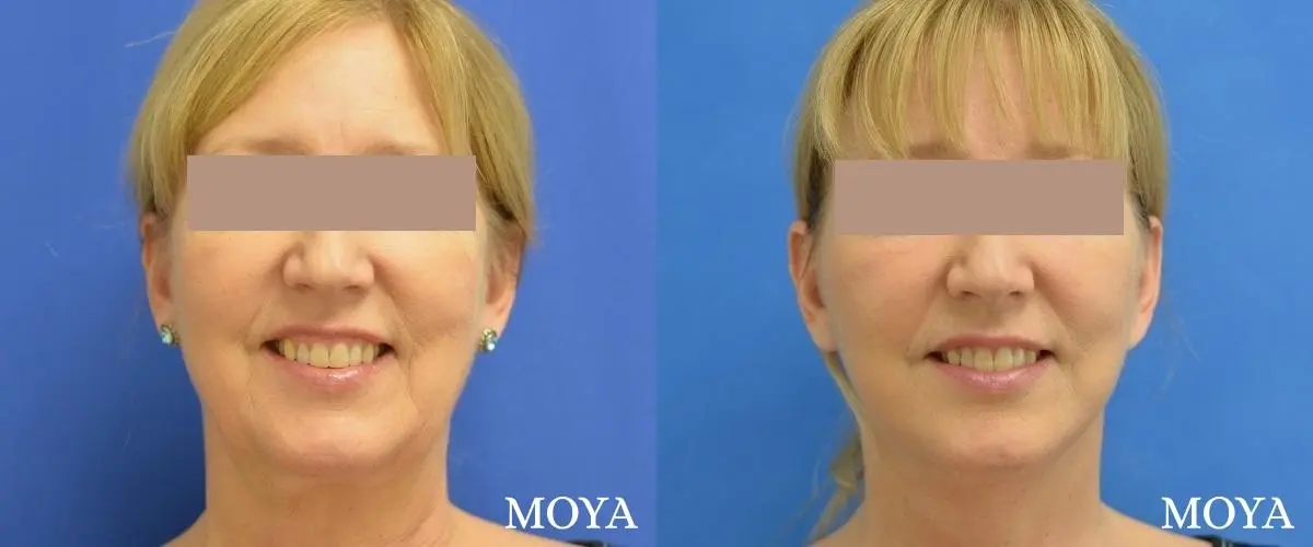 Facelift (Limited Lower) - Before and After 2