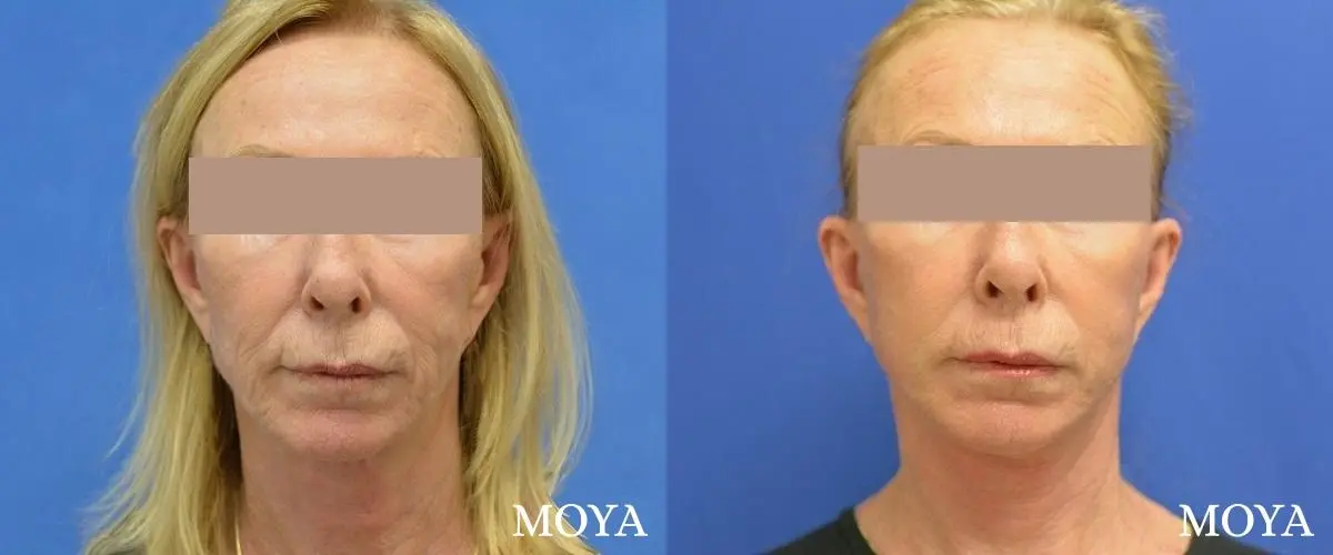 Facelift (Limited Lower) - Before and After 1