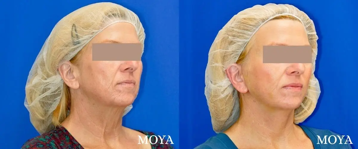 Facelift (Limited Lower) - Before and After 1