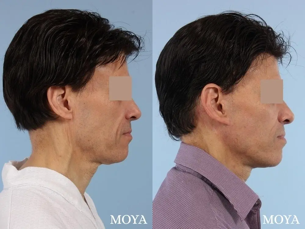 Facelift (Standard) - Before and After 2