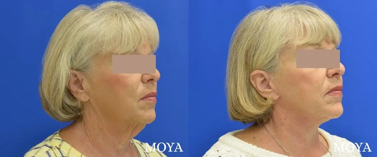 Facelift (Lower) - Before and After 1