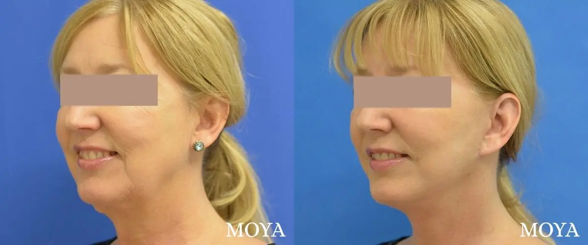 Facelift (Limited Lower) - Before and After 1
