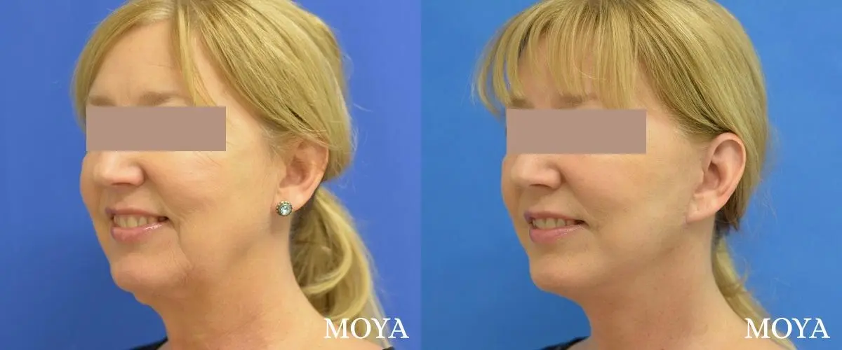 Facelift (Limited Lower) - Before and After  