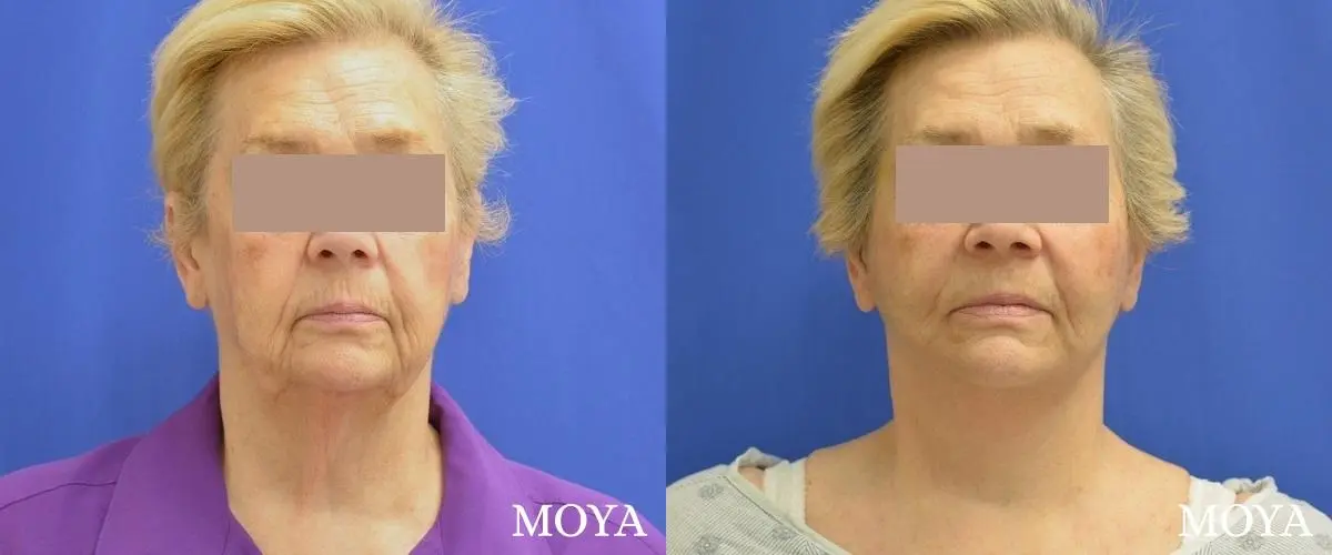 Facelift (Limited Lower) - Before and After 2