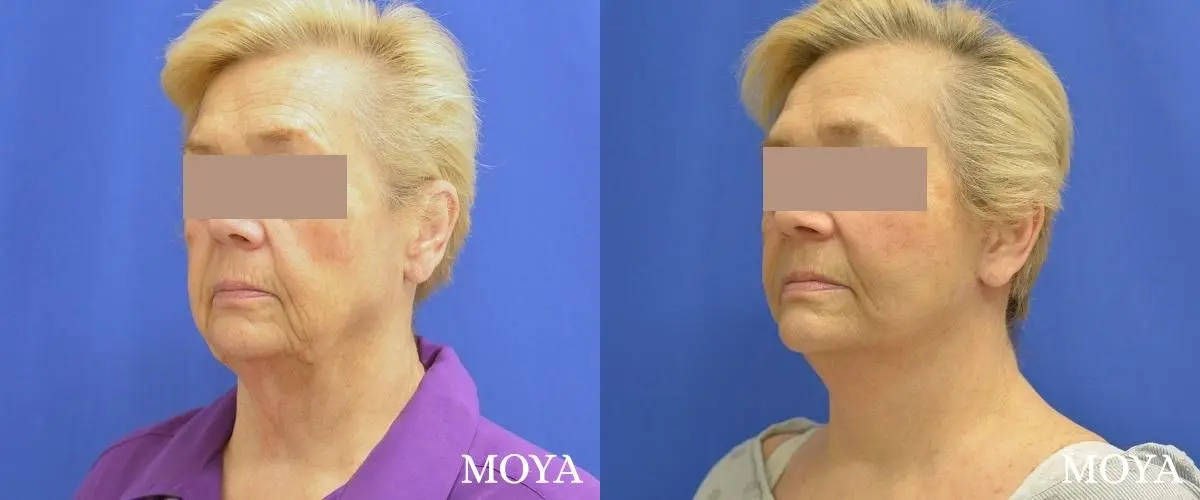 Facelift (Limited Lower) - Before and After  