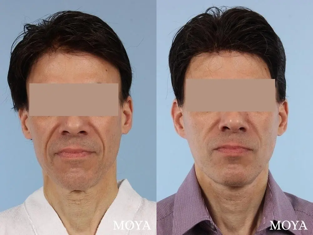 Facelift (Standard) - Before and After  