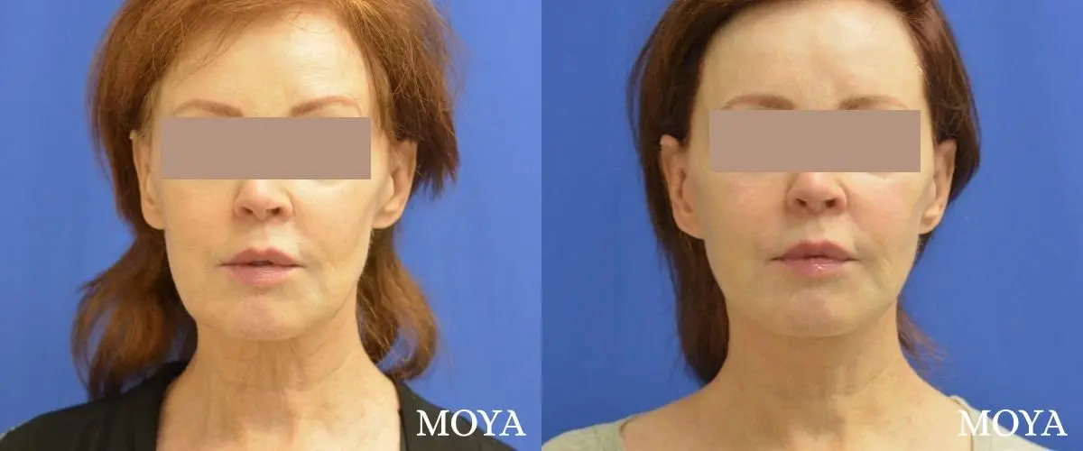 Facelift (Limited Lower) - Before and After 2