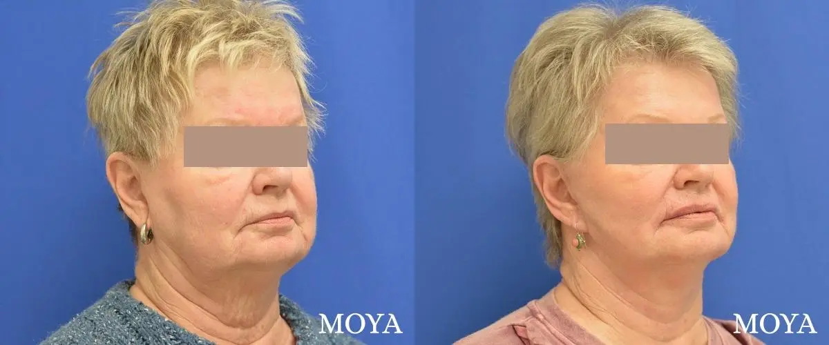 Facelift (Limited Lower) - Before and After  