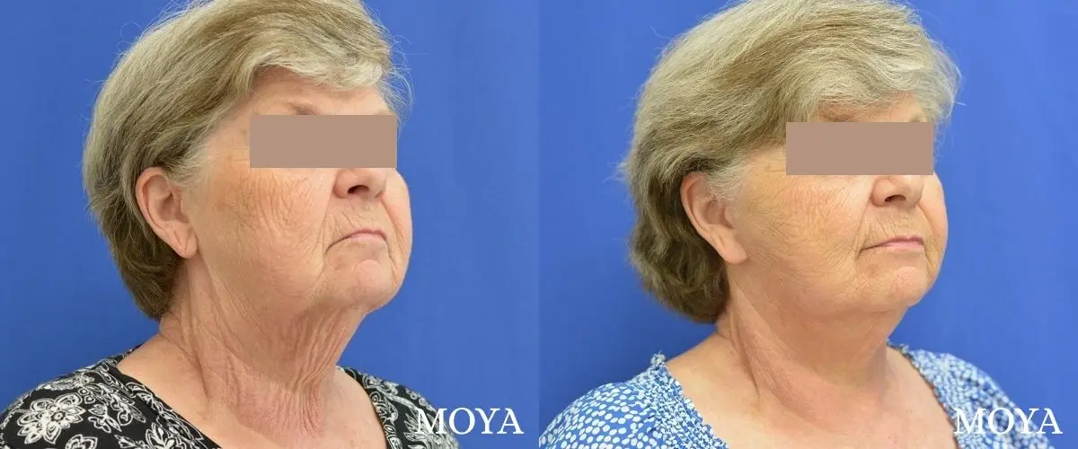 Facelift (Limited Lower) - Before and After 1