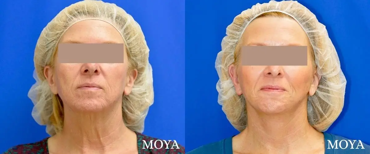 Facelift (Limited Lower) - Before and After 2