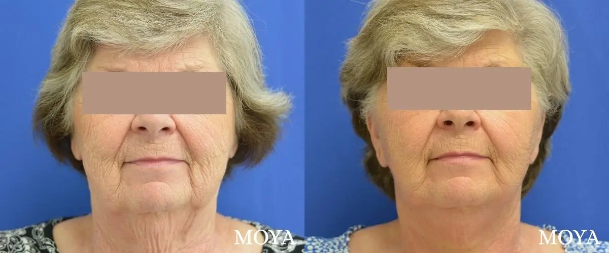 Facelift (Limited Lower) - Before and After 2