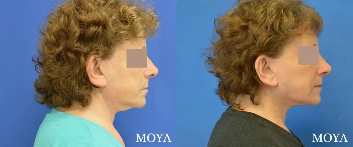 Facelift (Lower) - Before and After  
