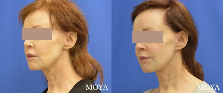 Facelift (Limited Lower) - Before and After  