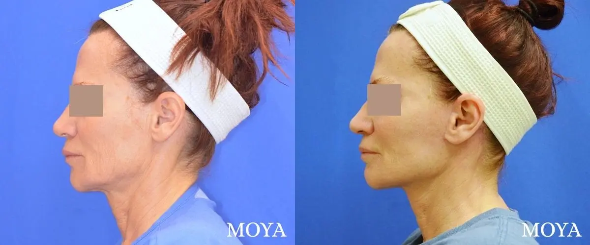 Facelift (Limited Lower) - Before and After  