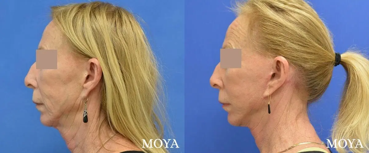 Facelift (Limited Lower) - Before and After 2