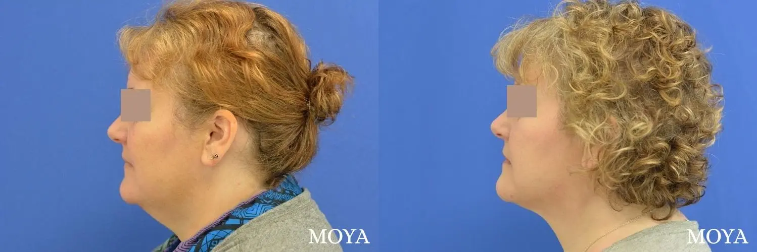 Facial Liposuction: Patient 1 - Before and After 2