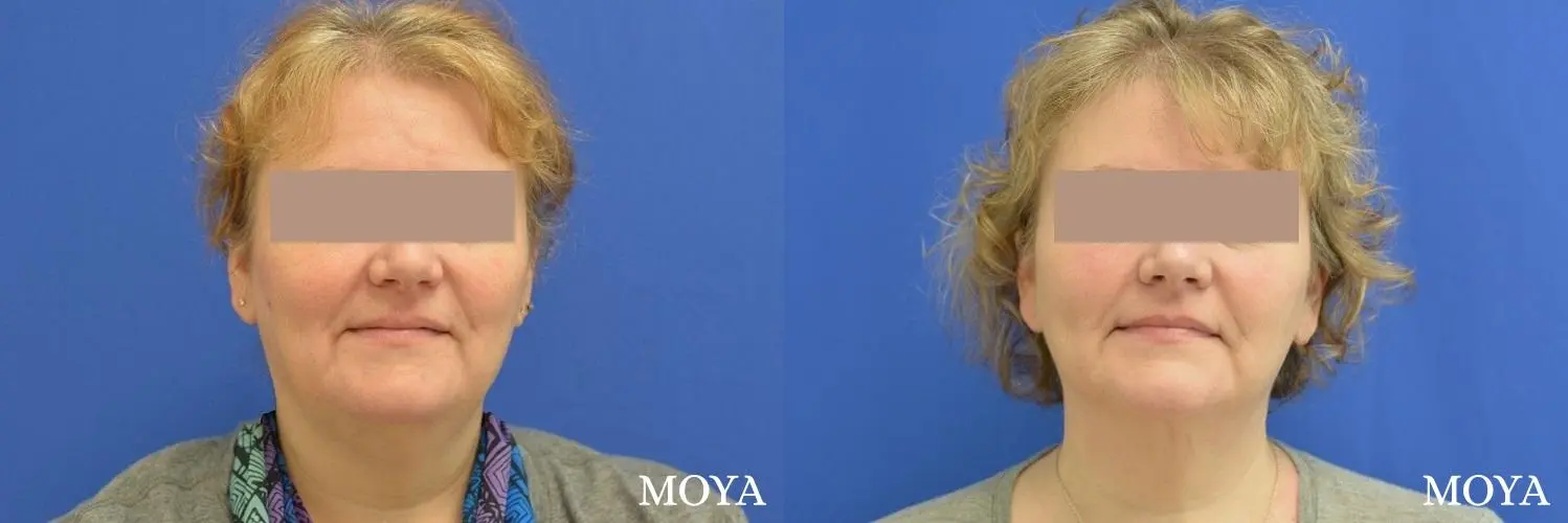 Facial Liposuction: Patient 1 - Before and After 1