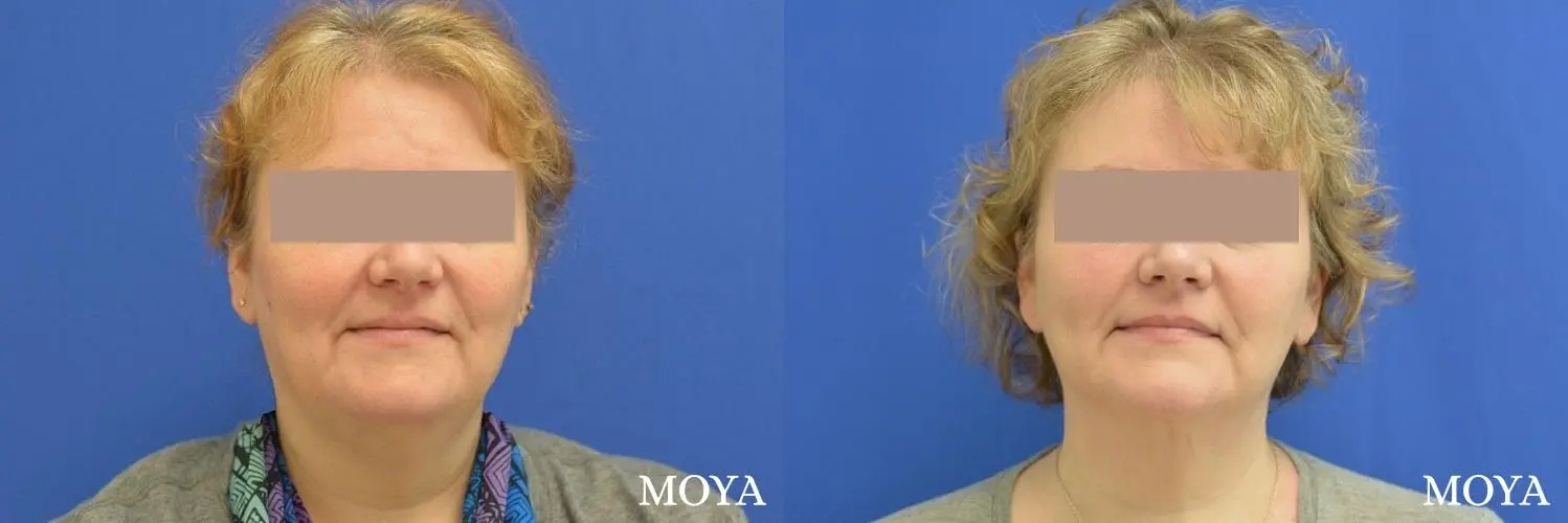 Facial Liposuction: Patient 1 - Before and After  