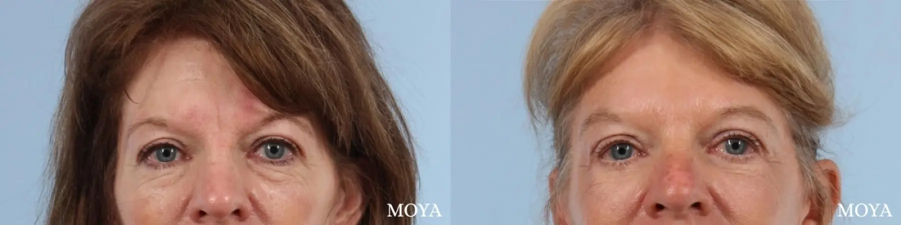 Fillers: Patient 13 - Before and After 1