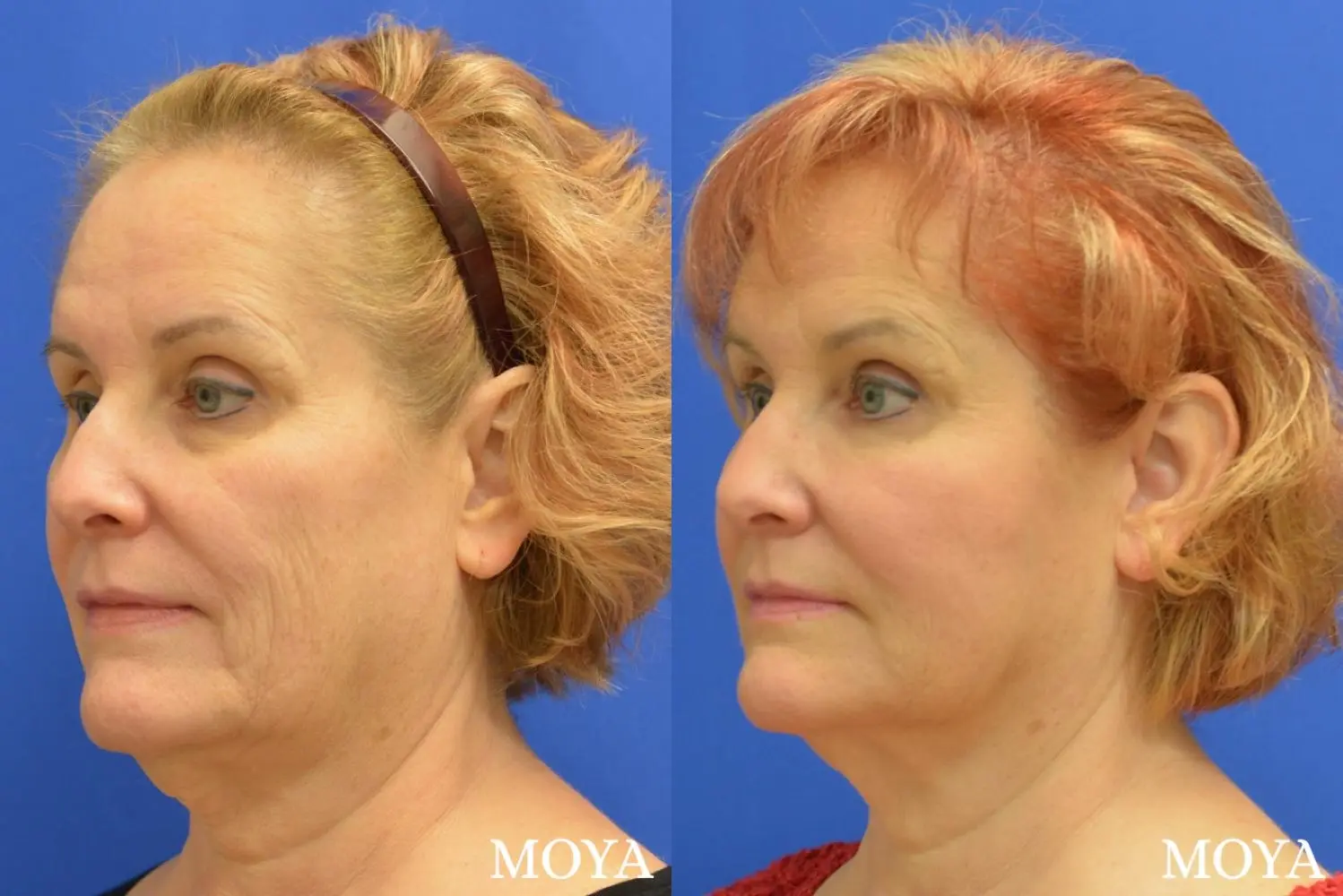 Fillers: Patient 12 - Before and After 2