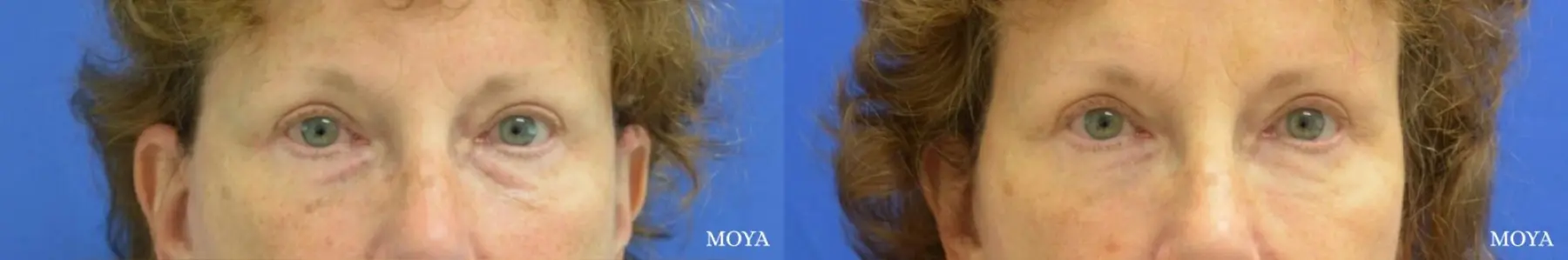 Fillers: Patient 7 - Before and After 1