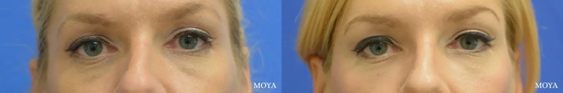 Fillers: Patient 5 - Before and After  