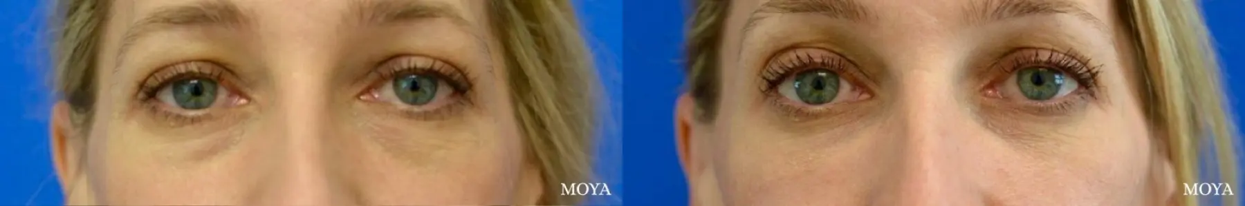 Fillers: Patient 6 - Before and After 1