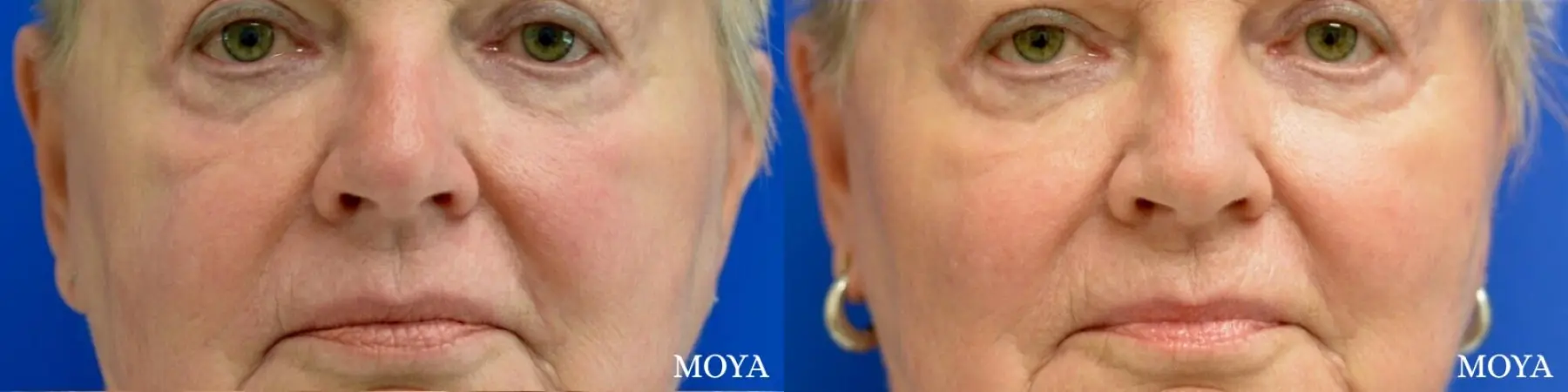 Fillers: Patient 8 - Before and After  
